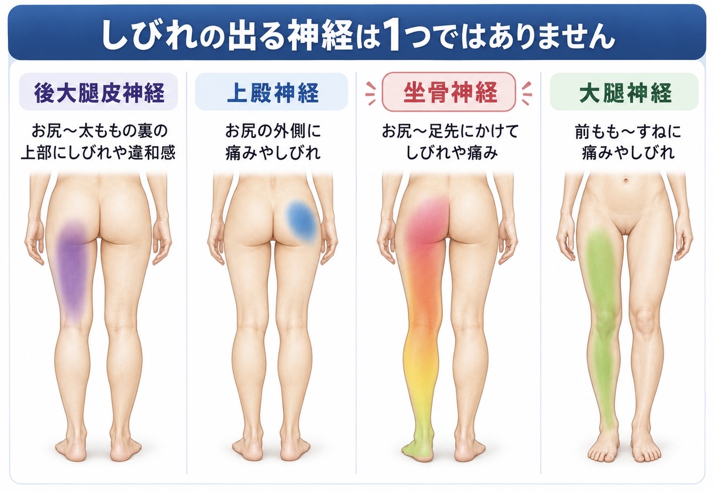 坐骨神経痛と呼ばれる症状の出方や神経の走行を示すイメージ
